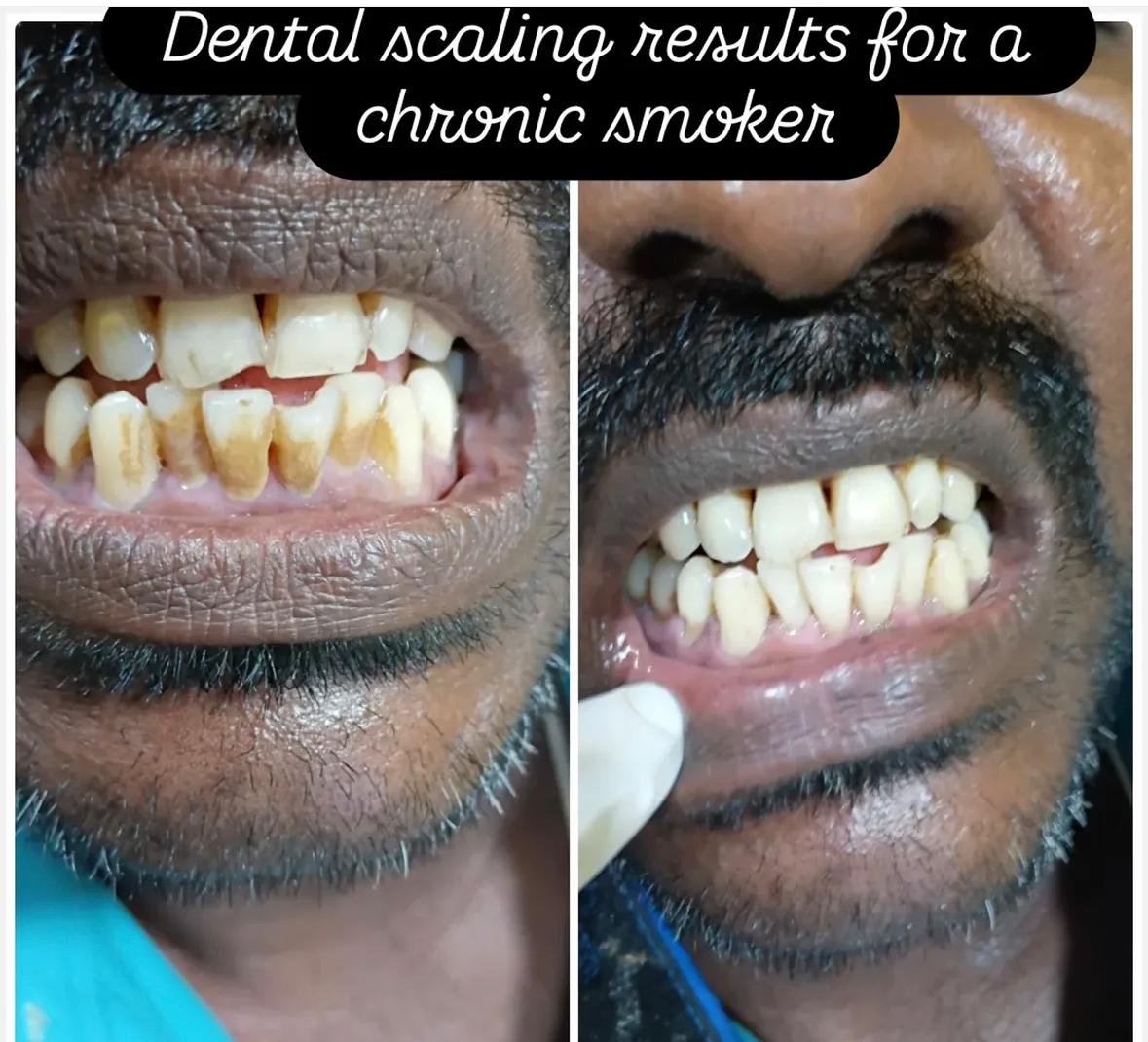 Before and after dental transformation